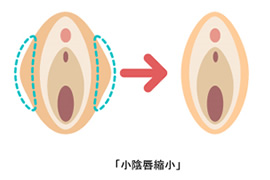 小陰唇縮小