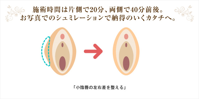 施術時間は片側で20分、両側で40分前後。お写真でのシュミレーションで納得のいくカタチへ。 「小陰唇の左右差を整える」