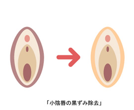 小陰唇の黒ずみ除去