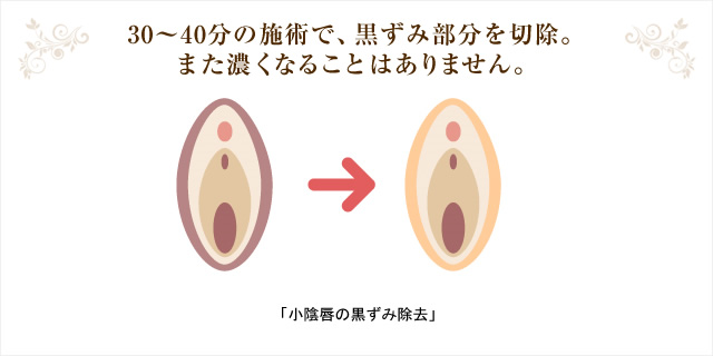 30?40分の施術で、黒ずみ部分を切除。また濃くなることはありません。「小陰唇の黒ずみ除去」