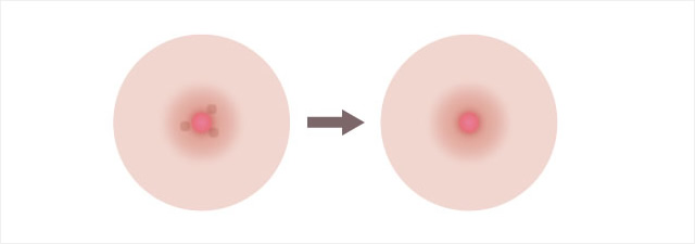 モントゴメリ腺切除のイメージ