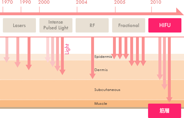 Lasers lntensePulsedLight RF Fractional HIFU 筋層