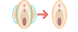 小陰唇を小さくしたい