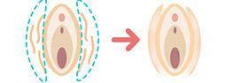 大陰唇をすっきりさせる