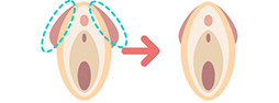 小陰唇と大陰唇の間にヒダがある