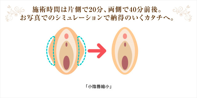 施術時間は片側で20分、両側で40分前後。 お写真でのシュミレーションで納得のいくカタチへ。「小陰唇縮小」