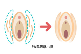 大陰唇脂肪注入