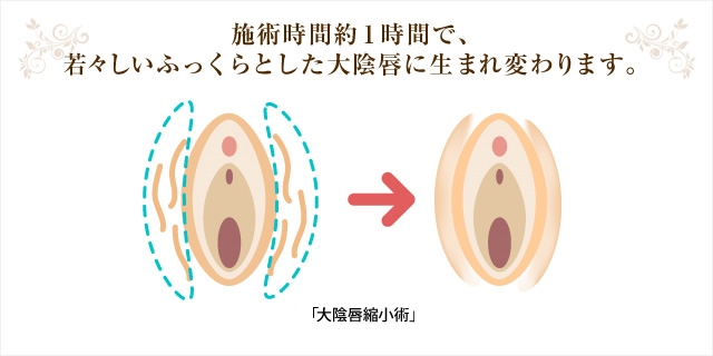 施術時間約1時間で、若々しいふっくらとした大陰唇に生まれ変わります。 「大陰唇脂肪注入」