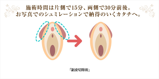 施術時間は片側で15分、両側で30分前後。お写真でのシュミレーションで納得のいくカタチへ。「副ヒダ除去術」