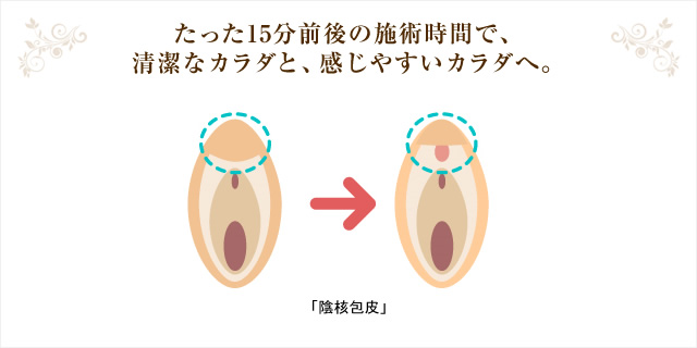 たった15分前後の施術時間で、 清潔なカラダと、感じやすいカラダへ。 「陰核包皮」