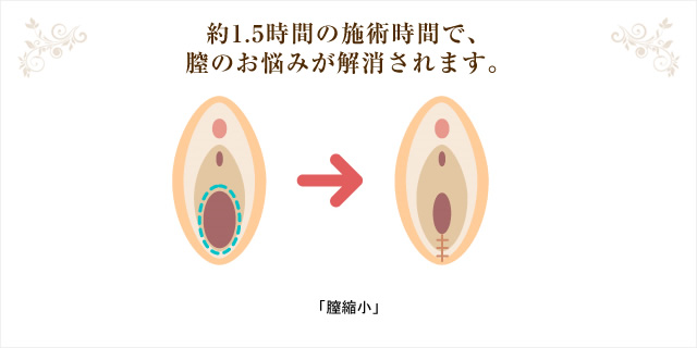 約1.5時間の施術時間で、膣のお悩みが解消されます。「膣縮小」