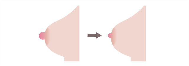 乳頭縮小術のイメージ