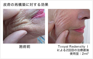 皮膚の再構築に対する効果 皮膚の再構築に対する効果