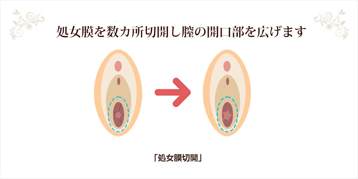処女膜切開の説明図
